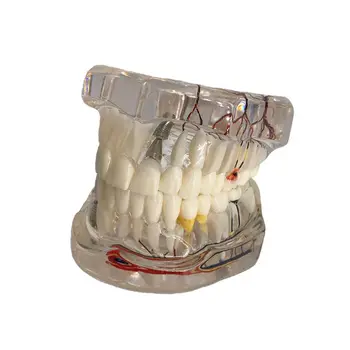 Десантный Имплантат Модель Зубов с Реставрационным Мостовидным протезом Стоматолог для Медицины